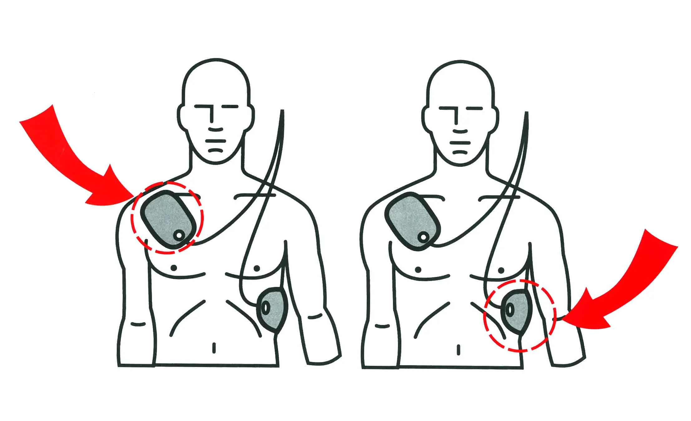 An illustration of where to put paddles for an automated defibrillator on an adult